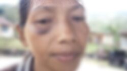 KDRT, Seorang Istri di Cibal Diduga Dianiaya Suami hingga Pingsan.